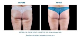 Cellutone BEFORE and After
