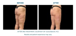 Cellutone BEFORE and After