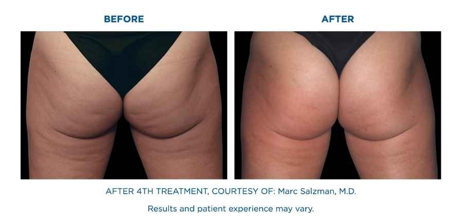 Cellulite Treatment before and after 4 weeks! Incredible Transformation is  waiting for you, the patient already tried 50 cellulite sessio