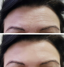 botox filler before and after