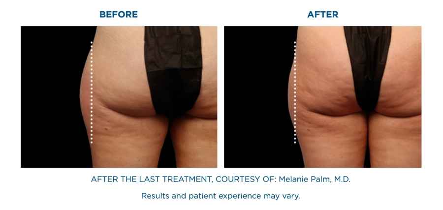 emsculpt NEO BEFORE and After