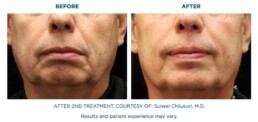 skin tightening BEFORE and After