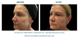skin tightening BEFORE and After