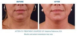 skin tightening BEFORE and After