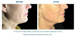 skin tightening BEFORE and After