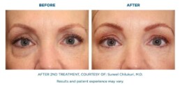 skin tightening BEFORE and After