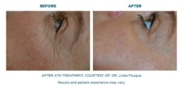 skin tightening BEFORE and After