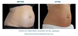skin tightening body BEFORE and After