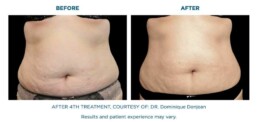 skin tightening body BEFORE and After