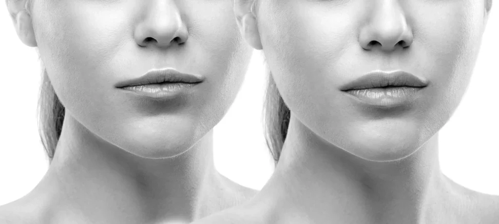 lip filler calgary