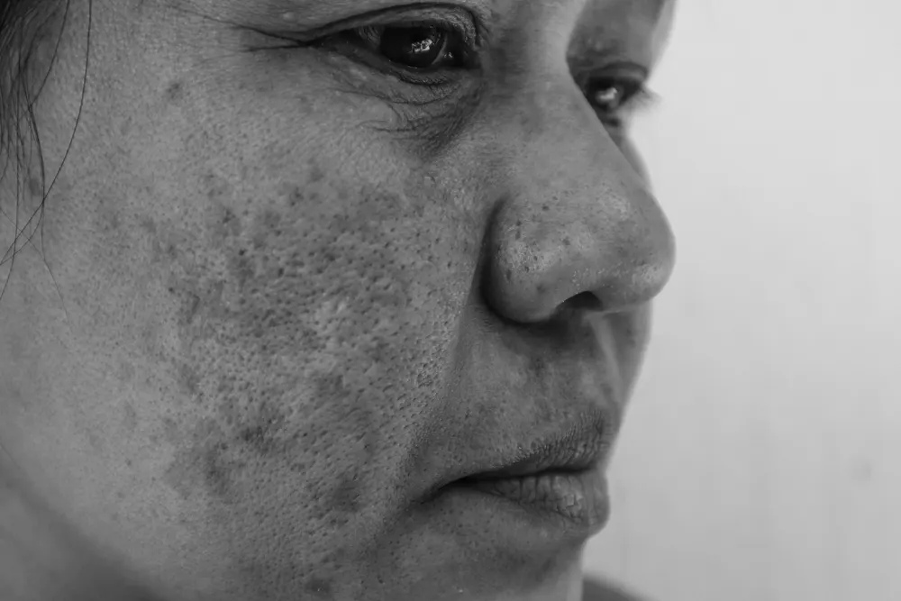 melasma calgary