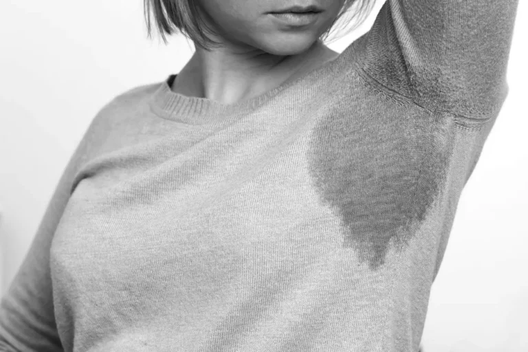 Hyperhidrosis Treatment Calgary: Botox for Excessive Sweating